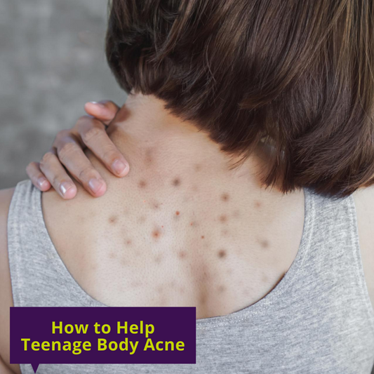 How to Help Teenage Body Acne