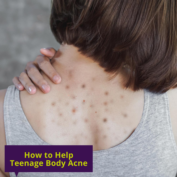 How to Help Teenage Body Acne